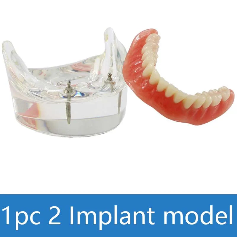 Dental Teeth Model with Implant Overdenture Model Inferior Demo Teeth Model for Dentist Study Dental Teaching Model 2/4 Implants