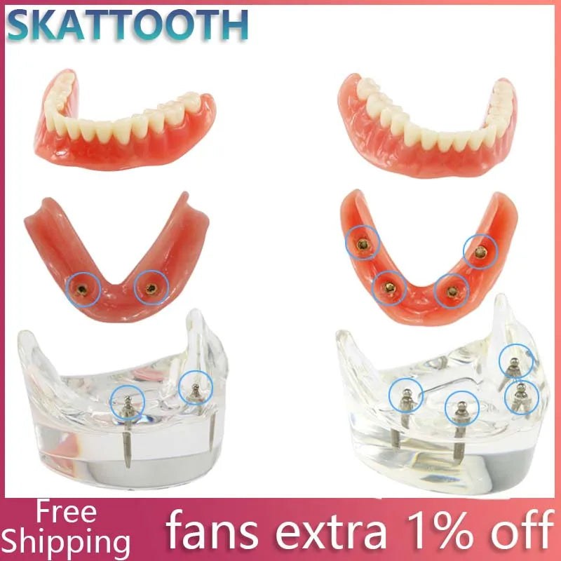 Dental Teeth Model with Implant Overdenture Model Inferior Demo Teeth Model for Dentist Study Dental Teaching Model 2/4 Implants