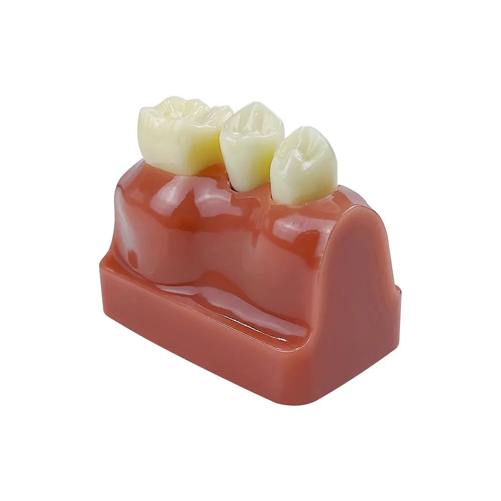 Dental 4 Times Implant Teeth model Analysis Crown Bridge Demonstration Removable Model Dentisty Study Training Teaching Model