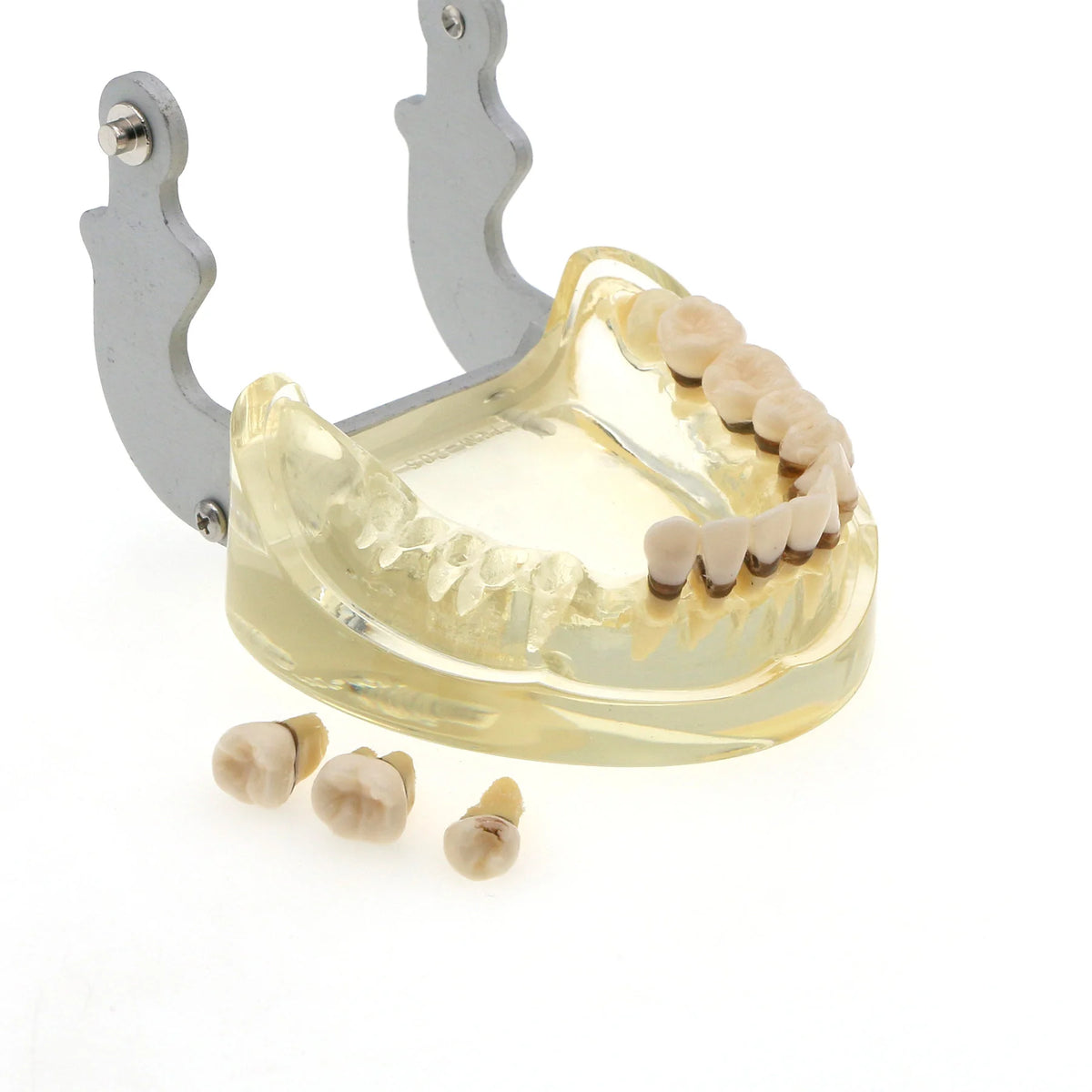 Dental Teeth Model  Dentist Teaching Model Demonstration Periodontal Disease Pathological For Patient Education Demo M4017