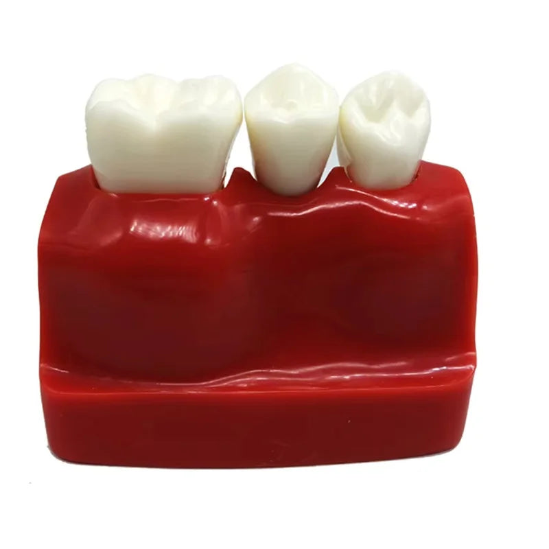 Dental 4 Times Implant Teeth model Analysis Crown Bridge Demonstration Removable Model Dentisty Study Training Teaching Model