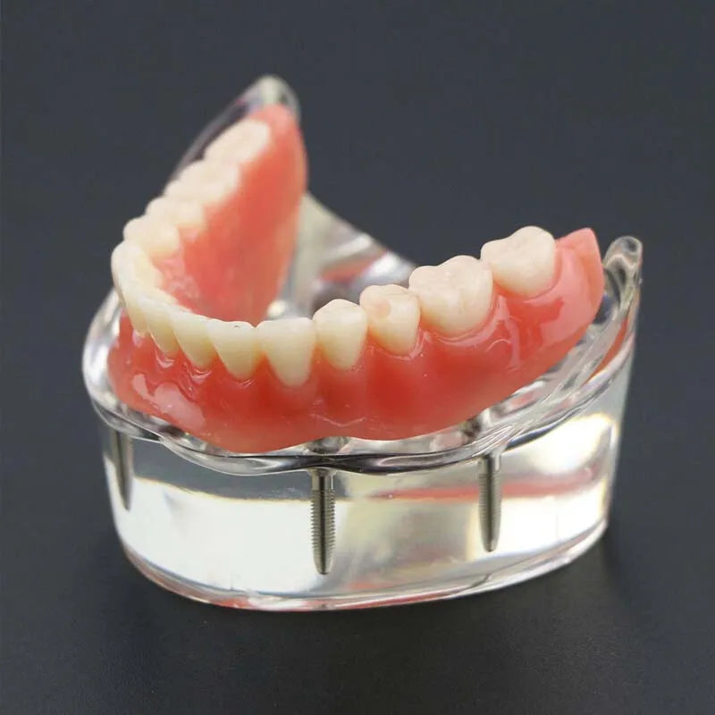 Dental Teeth Model with Implant Overdenture Model Inferior Demo Teeth Model for Dentist Study Dental Teaching Model 2/4 Implants