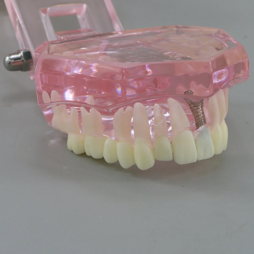 Dental Models Pink Disease Tooth Model Typodont Implant With Removable Tooth Restoration Bridge Teaching Tooth Model  M2001P