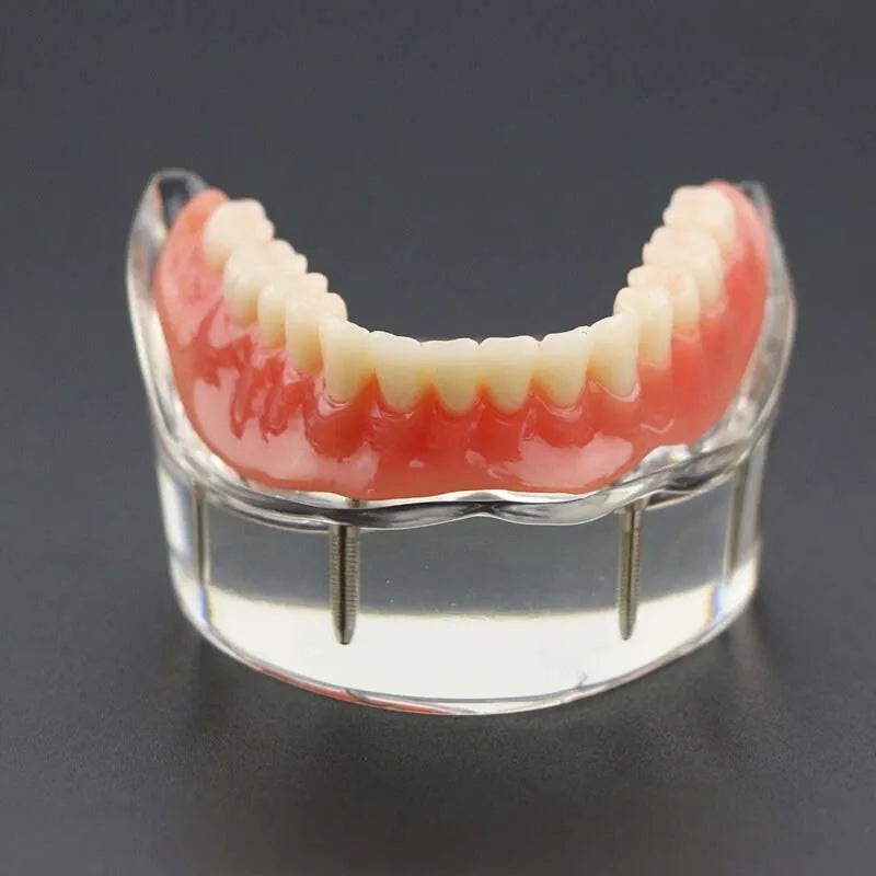 Dental Teeth Model with Implant Overdenture Model Inferior Demo Teeth Model for Dentist Study Dental Teaching Model 2/4 Implants