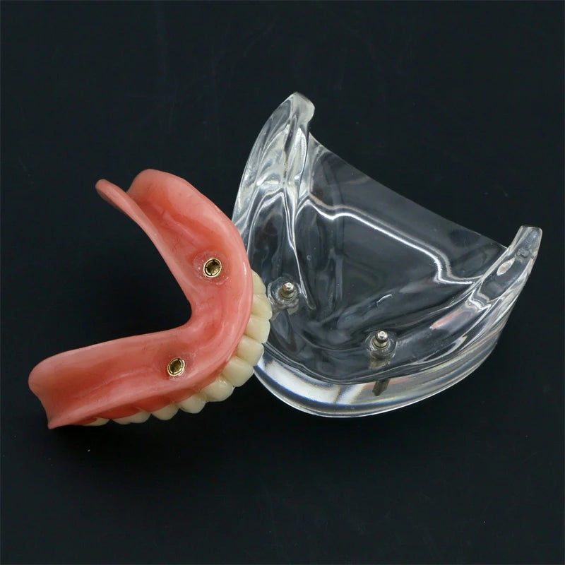Dental Teeth Model with Implant Overdenture Model Inferior Demo Teeth Model for Dentist Study Dental Teaching Model 2/4 Implants