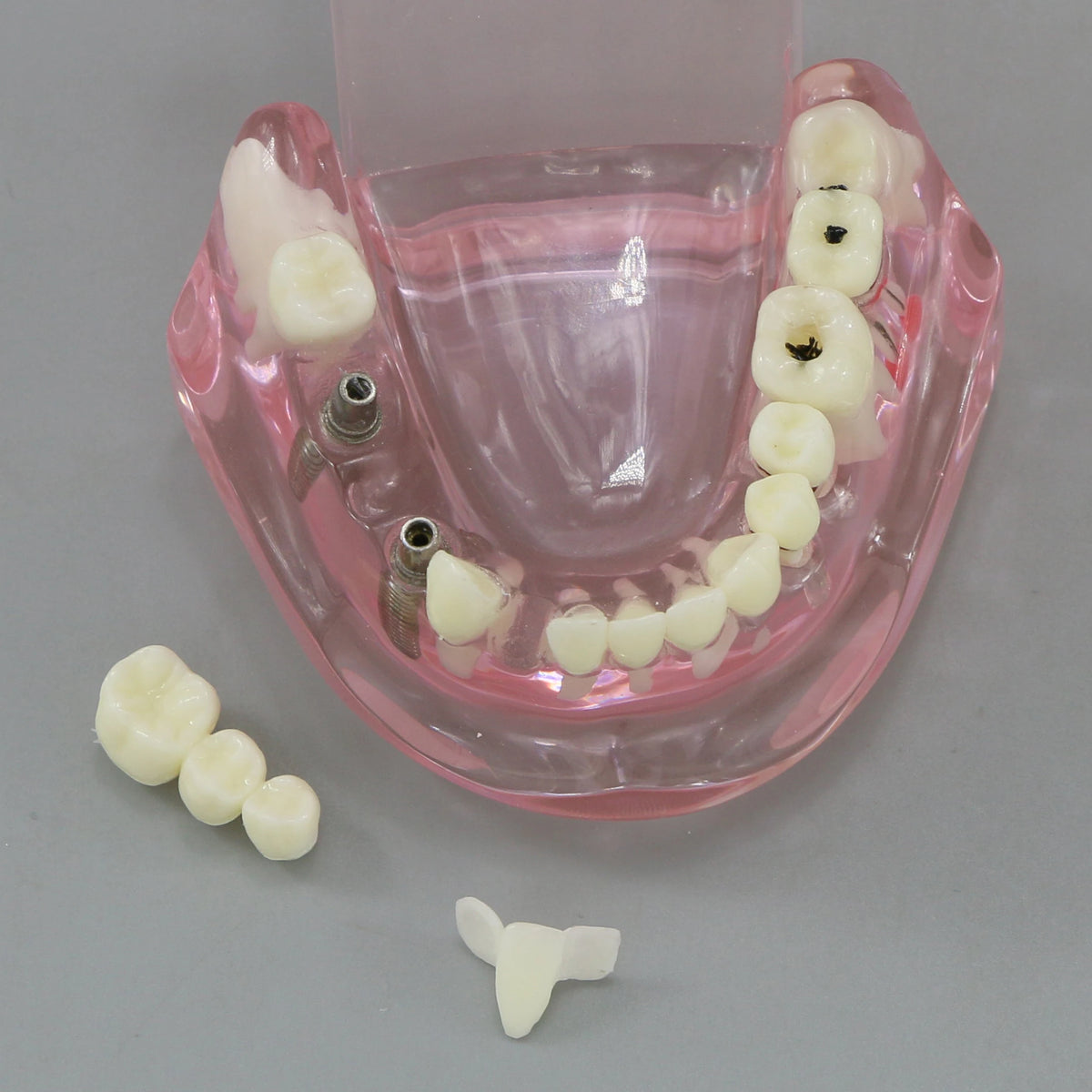 Dental Models Pink Disease Tooth Model Typodont Implant With Removable Tooth Restoration Bridge Teaching Tooth Model  M2001P