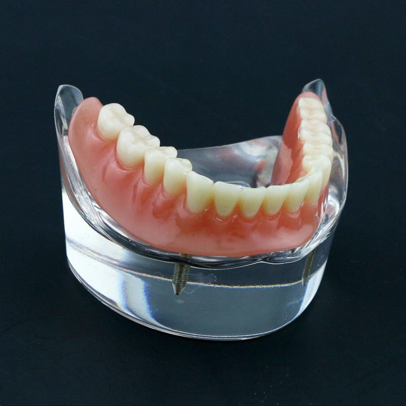 Dental Teeth Model with Implant Overdenture Model Inferior Demo Teeth Model for Dentist Study Dental Teaching Model 2/4 Implants
