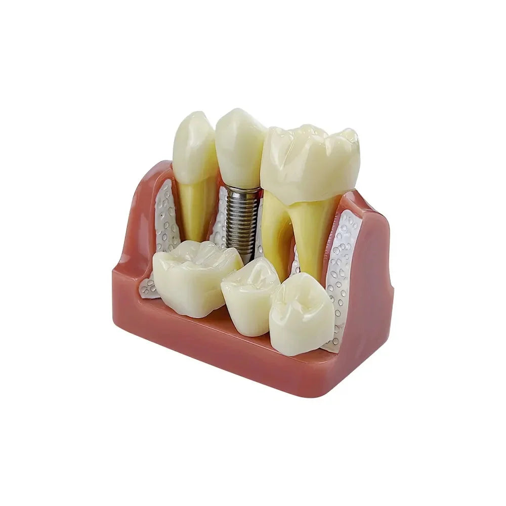 Dental 4 Times Implant Teeth model Analysis Crown Bridge Demonstration Removable Model Dentisty Study Training Teaching Model