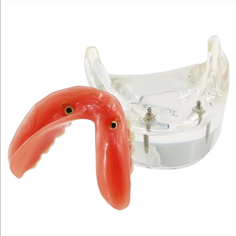 Dental Teeth Model with Implant Overdenture Model Inferior Demo Teeth Model for Dentist Study Dental Teaching Model 2/4 Implants