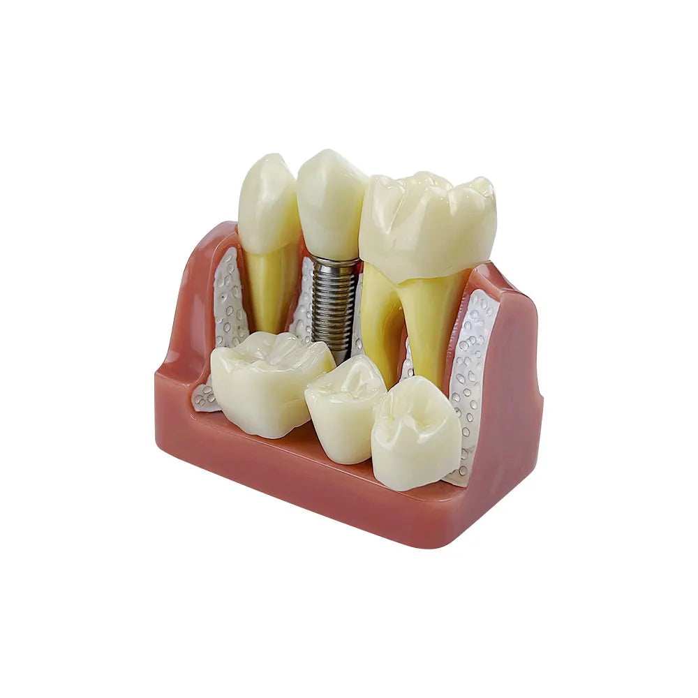 Dental 4 Times Implant Teeth model Analysis Crown Bridge Demonstration Removable Model Dentisty Study Training Teaching Model
