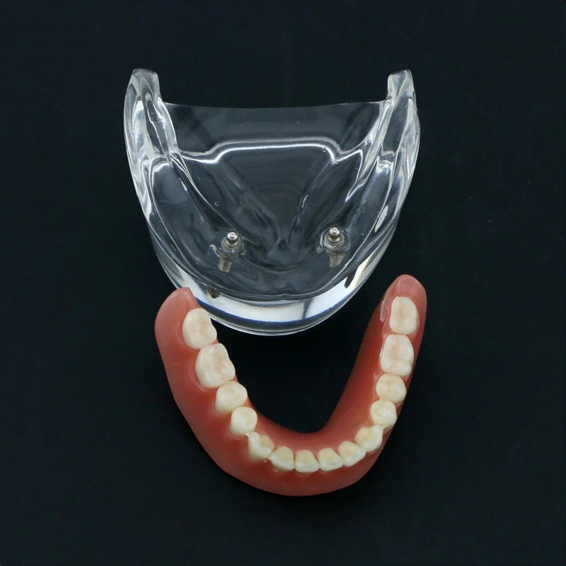 Dental Teeth Model with Implant Overdenture Model Inferior Demo Teeth Model for Dentist Study Dental Teaching Model 2/4 Implants