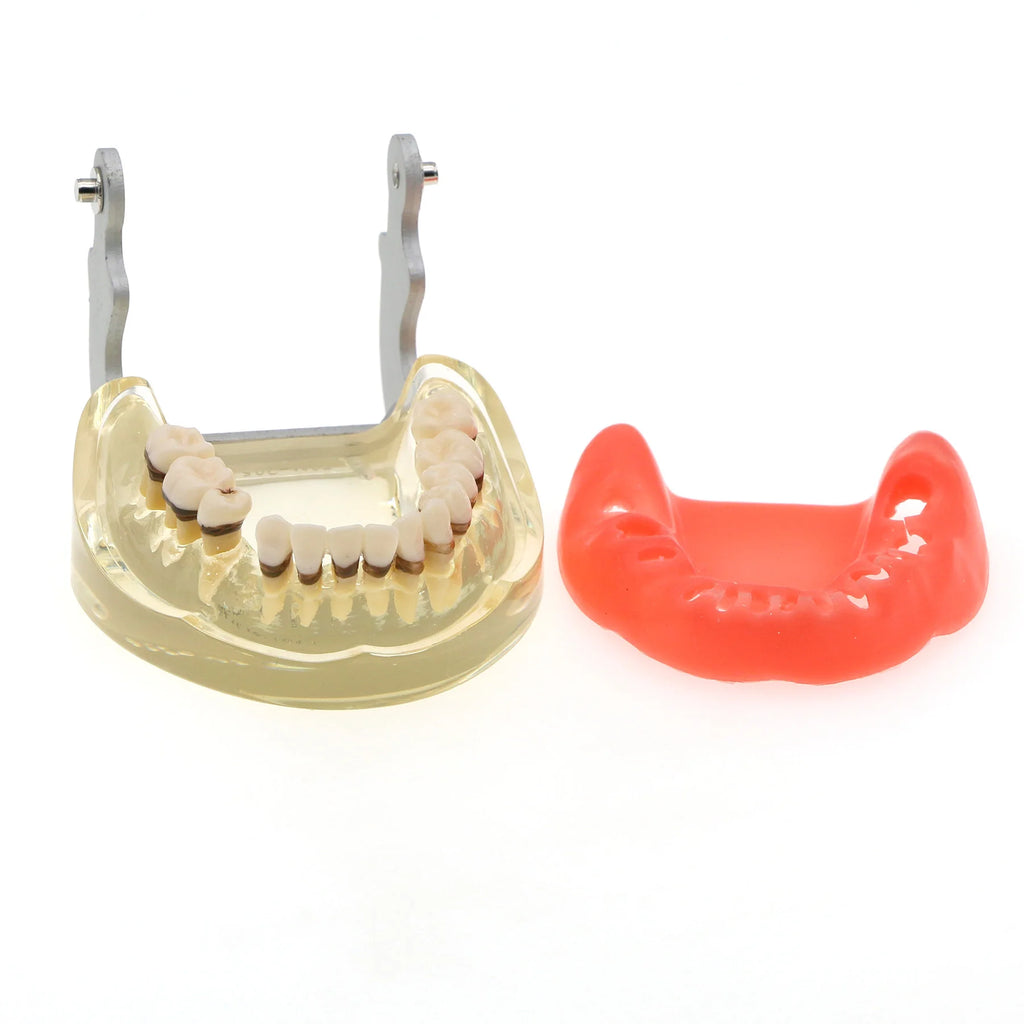 Dental Teeth Model  Dentist Teaching Model Demonstration Periodontal Disease Pathological For Patient Education Demo M4017