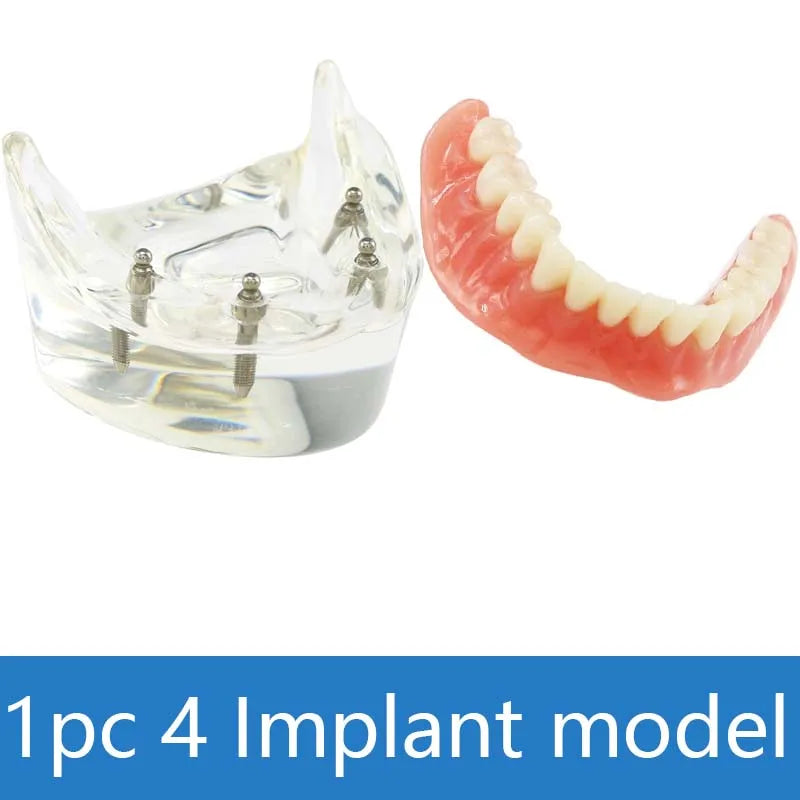 Dental Teeth Model with Implant Overdenture Model Inferior Demo Teeth Model for Dentist Study Dental Teaching Model 2/4 Implants
