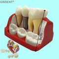 Dental 4 Times Implant Teeth model Analysis Crown Bridge Demonstration Removable Model Dentisty Study Training Teaching Model