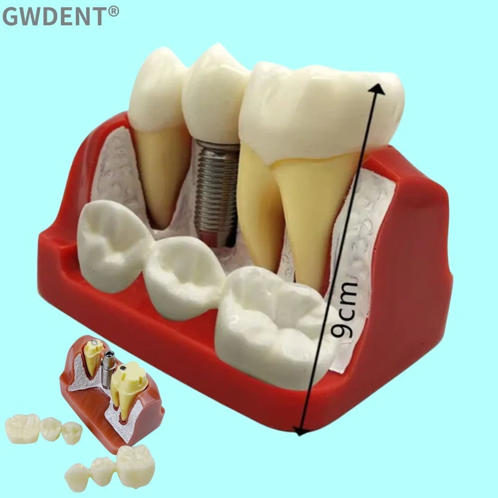 Dental 4 Times Implant Teeth model Analysis Crown Bridge Demonstration Removable Model Dentisty Study Training Teaching Model