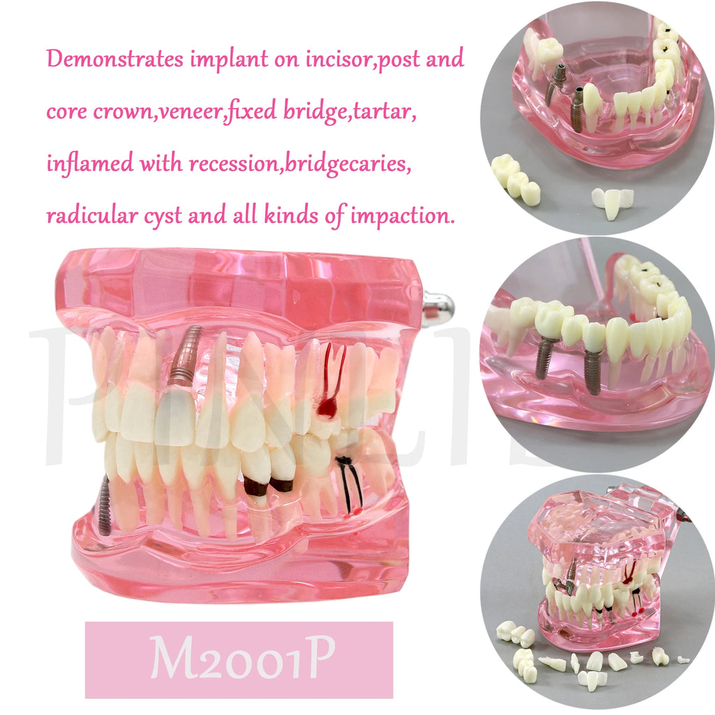 Dental Models Pink Disease Tooth Model Typodont Implant With Removable Tooth Restoration Bridge Teaching Tooth Model  M2001P