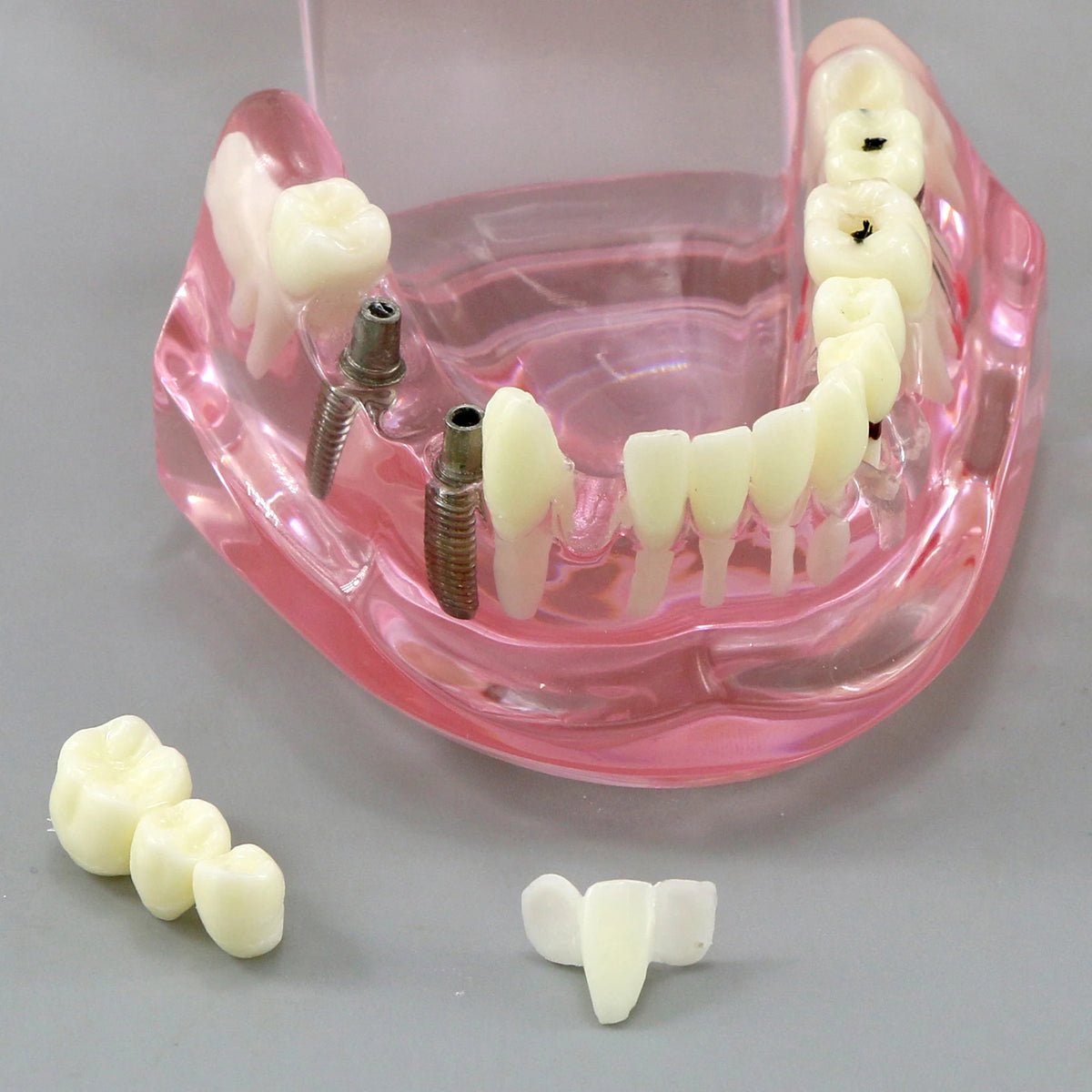Dental Models Pink Disease Tooth Model Typodont Implant With Removable Tooth Restoration Bridge Teaching Tooth Model  M2001P