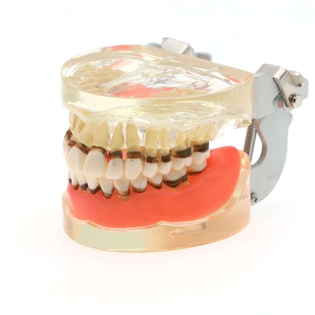 Dental Teeth Model  Dentist Teaching Model Demonstration Periodontal Disease Pathological For Patient Education Demo M4017