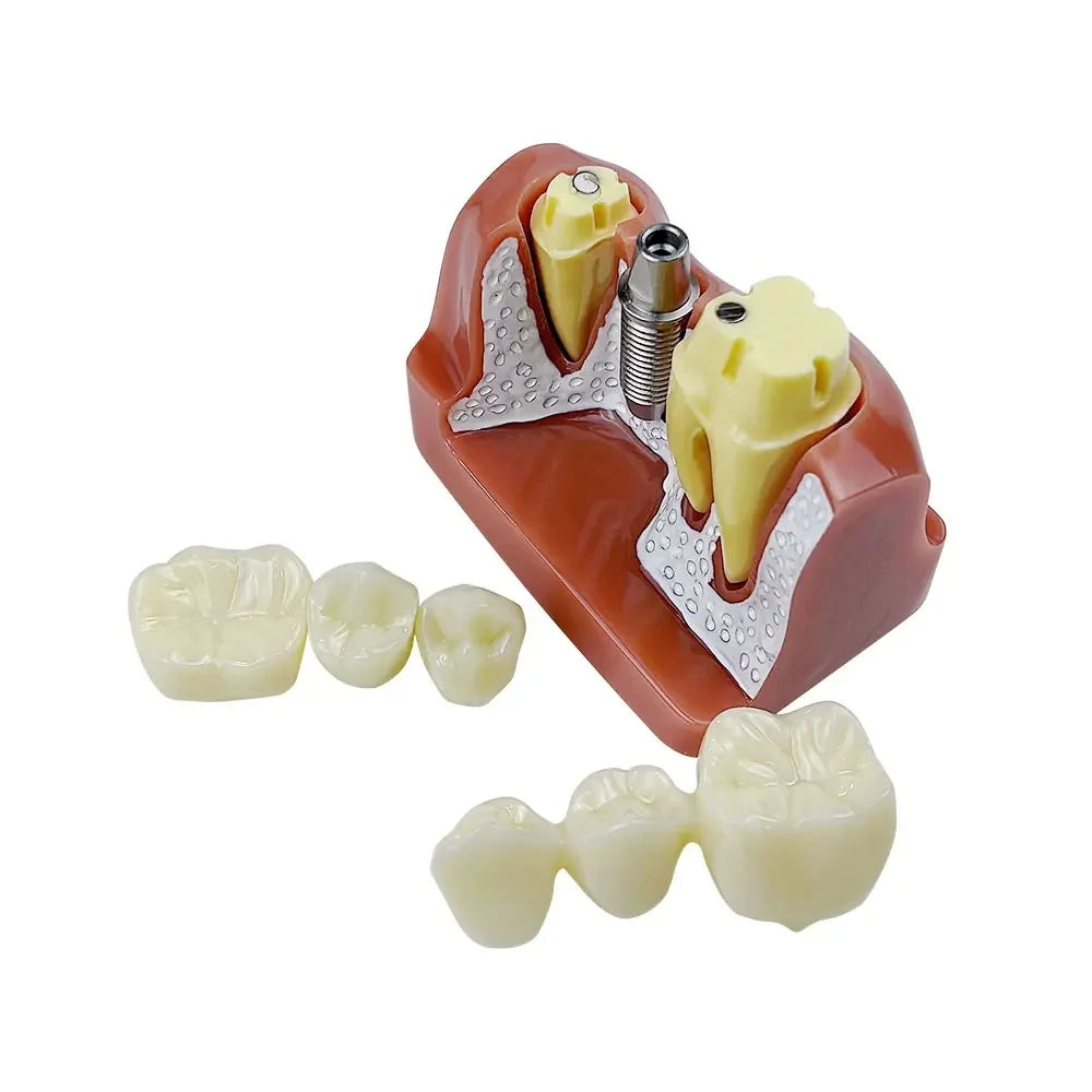 Dental 4 Times Implant Teeth model Analysis Crown Bridge Demonstration Removable Model Dentisty Study Training Teaching Model