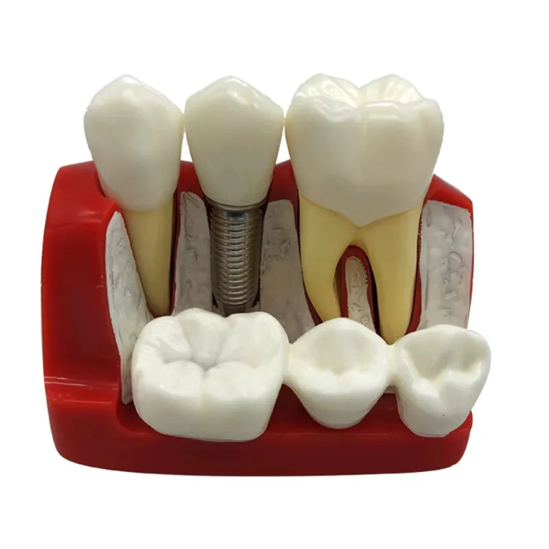 Dental 4 Times Implant Teeth model Analysis Crown Bridge Demonstration Removable Model Dentisty Study Training Teaching Model