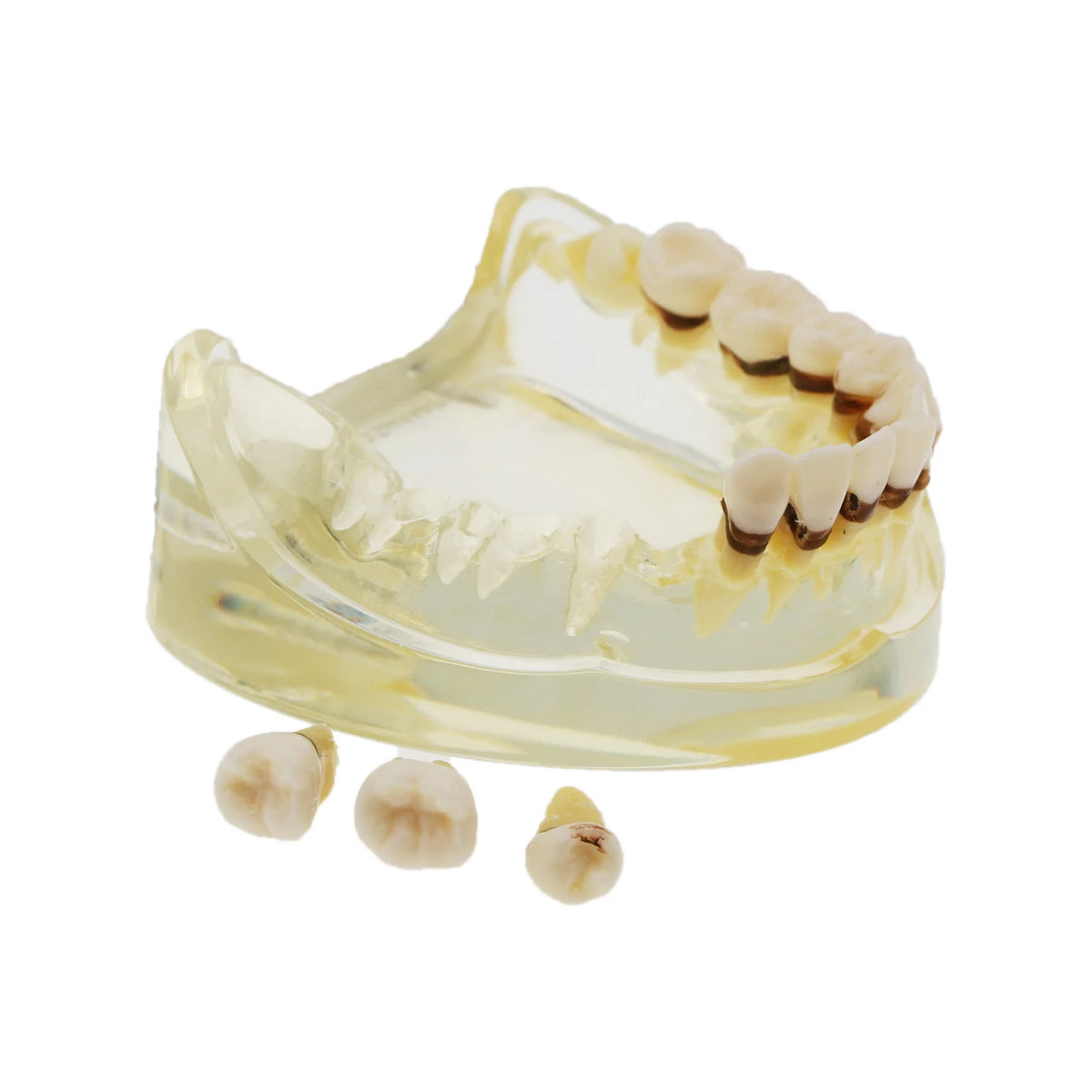 Dental Teeth Model  Dentist Teaching Model Demonstration Periodontal Disease Pathological For Patient Education Demo M4017