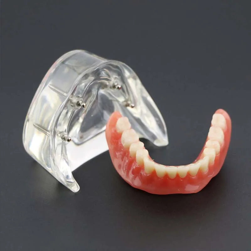 Dental Teeth Model with Implant Overdenture Model Inferior Demo Teeth Model for Dentist Study Dental Teaching Model 2/4 Implants