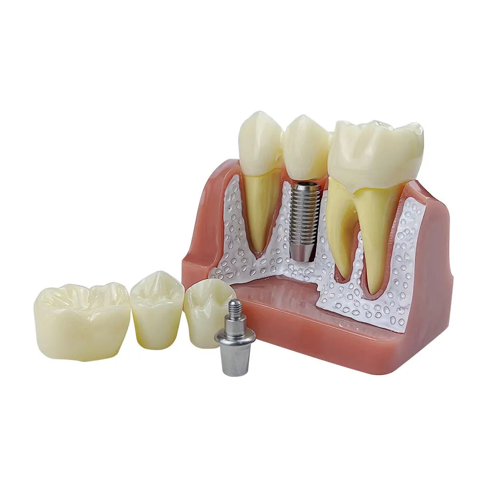 Dental 4 Times Implant Teeth model Analysis Crown Bridge Demonstration Removable Model Dentisty Study Training Teaching Model
