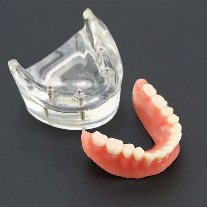 Dental Teeth Model with Implant Overdenture Model Inferior Demo Teeth Model for Dentist Study Dental Teaching Model 2/4 Implants