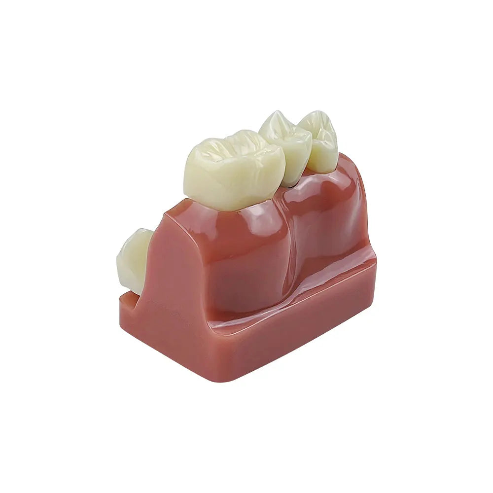 Dental 4 Times Implant Teeth model Analysis Crown Bridge Demonstration Removable Model Dentisty Study Training Teaching Model