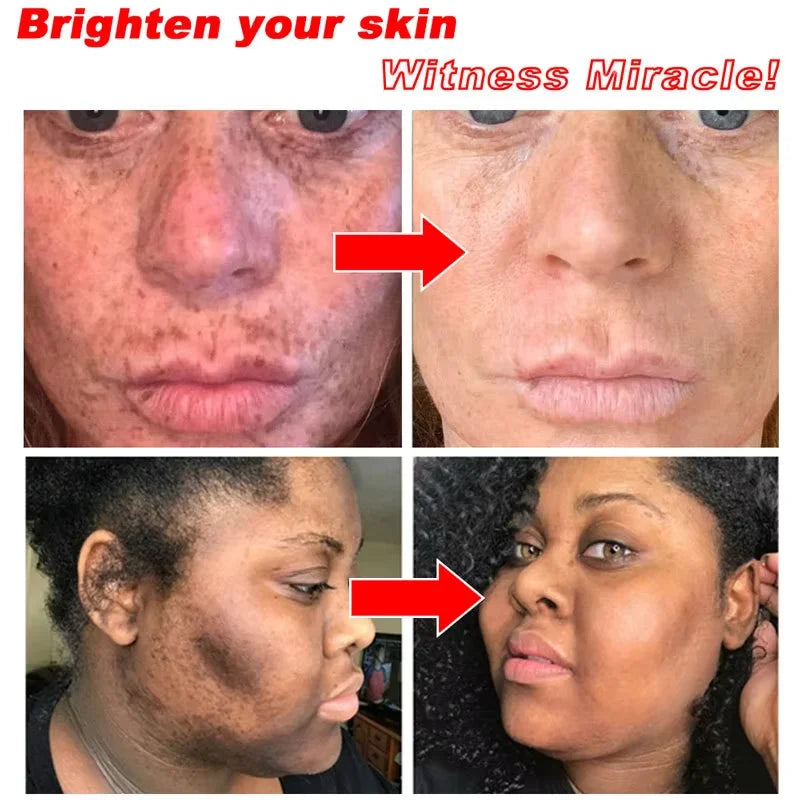 Vitamin C Whitening Freckles Serum Stick Remove Melasma Dark Spots Corrector Lighten Melanin Acne Anti-Aging Brighten Skin Care