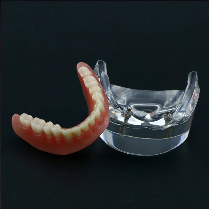 Dental Teeth Model with Implant Overdenture Model Inferior Demo Teeth Model for Dentist Study Dental Teaching Model 2/4 Implants