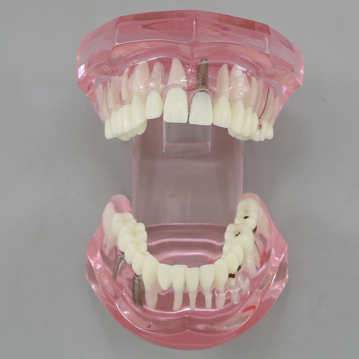 Dental Models Pink Disease Tooth Model Typodont Implant With Removable Tooth Restoration Bridge Teaching Tooth Model  M2001P