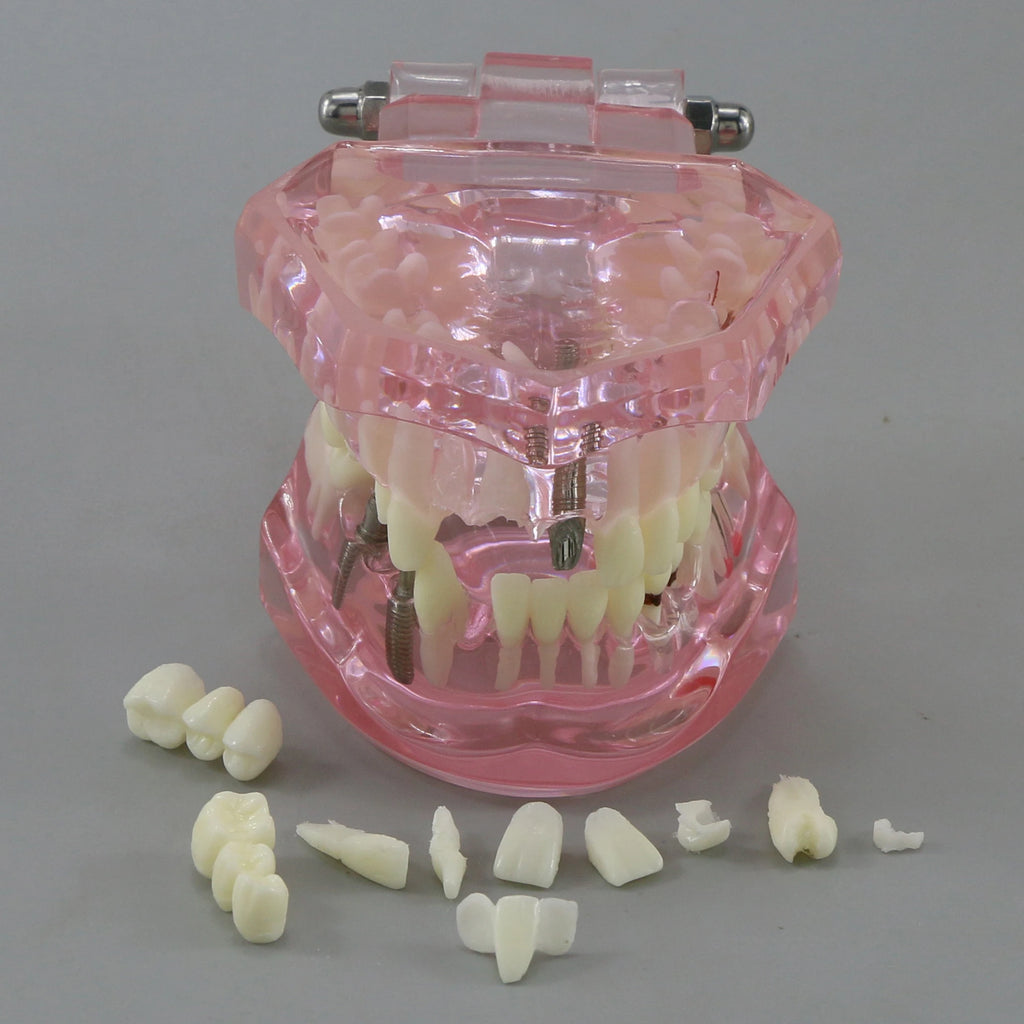 Dental Models Pink Disease Tooth Model Typodont Implant With Removable Tooth Restoration Bridge Teaching Tooth Model  M2001P