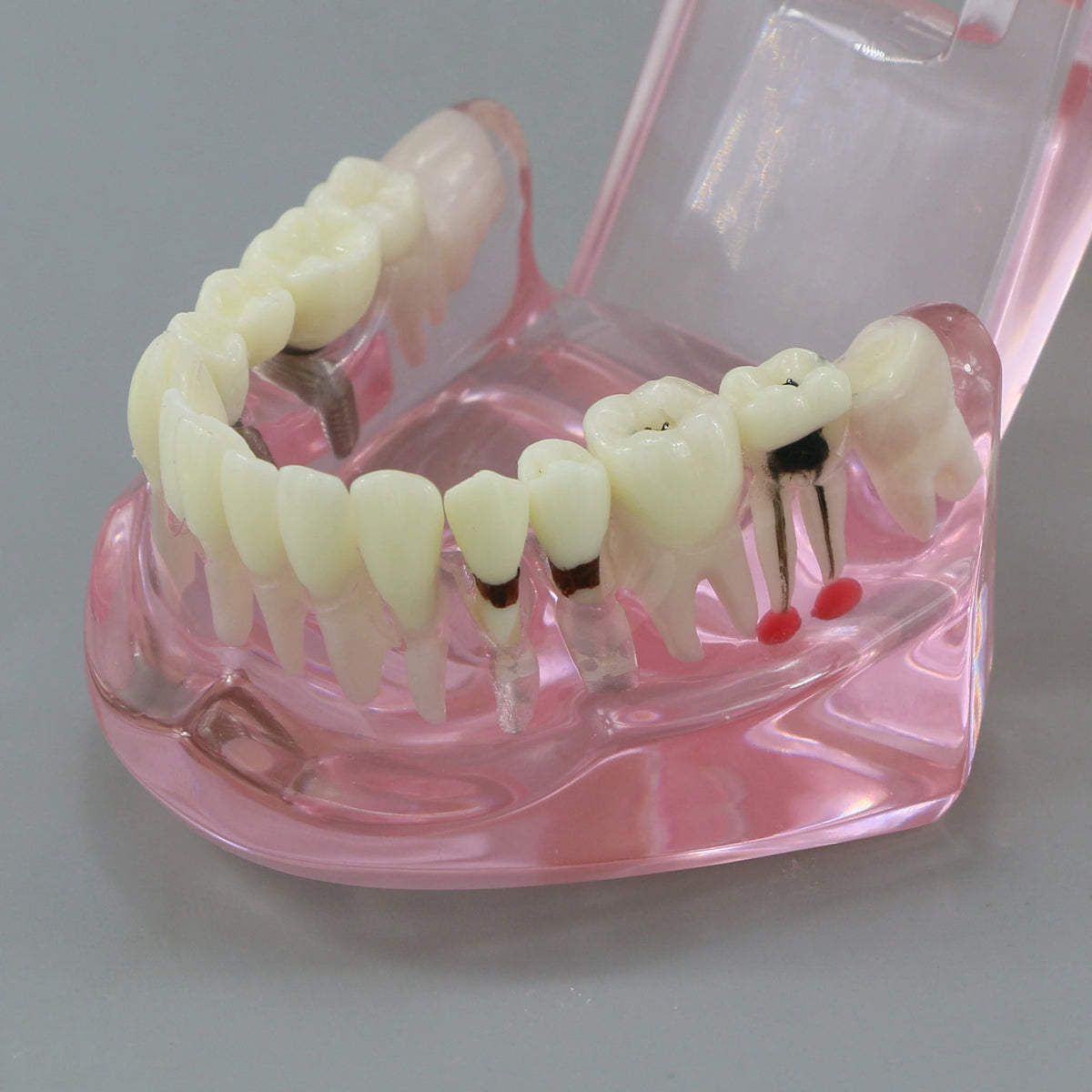 Dental Models Pink Disease Tooth Model Typodont Implant With Removable Tooth Restoration Bridge Teaching Tooth Model  M2001P