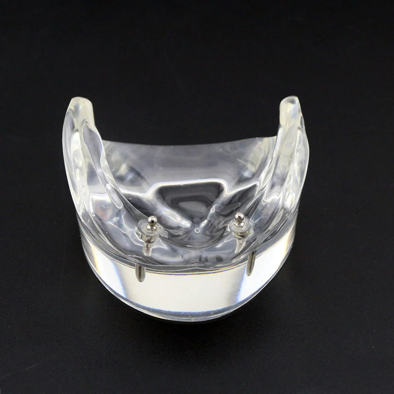 Dental Teeth Model with Implant Overdenture Model Inferior Demo Teeth Model for Dentist Study Dental Teaching Model 2/4 Implants