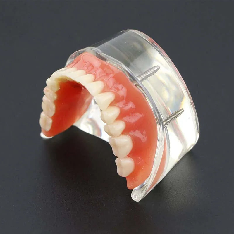 Dental Teeth Model with Implant Overdenture Model Inferior Demo Teeth Model for Dentist Study Dental Teaching Model 2/4 Implants