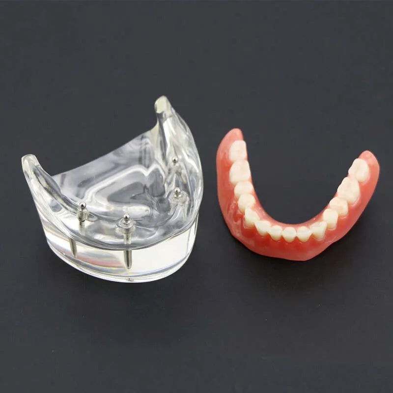 Dental Teeth Model with Implant Overdenture Model Inferior Demo Teeth Model for Dentist Study Dental Teaching Model 2/4 Implants