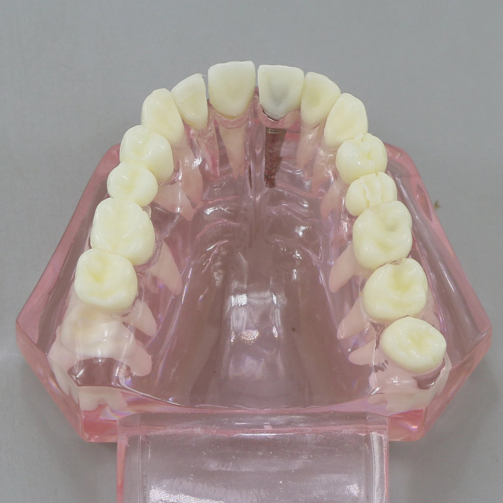 Dental Models Pink Disease Tooth Model Typodont Implant With Removable Tooth Restoration Bridge Teaching Tooth Model  M2001P