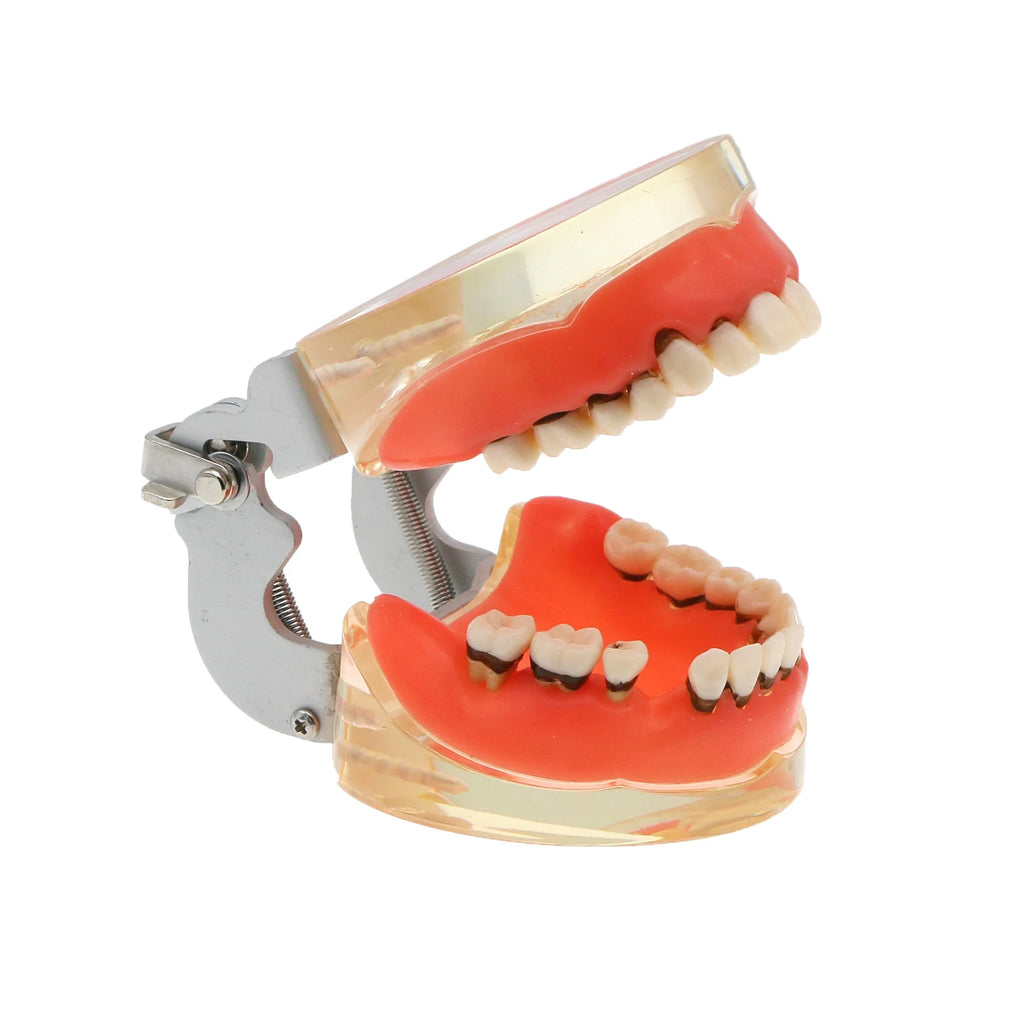 Dental Teeth Model  Dentist Teaching Model Demonstration Periodontal Disease Pathological For Patient Education Demo M4017
